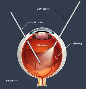 Υαλοειδεκτομή