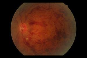 Retinal Artery Occlusion