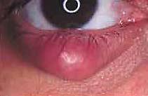 Chalazion Chalazion