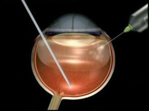 Εισαγωγή φυσαλίδας αερίου