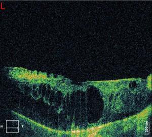 OCT with Diabetic Macular Oedema (DMO)