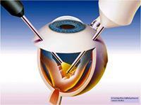 υαλοειδεκτομή