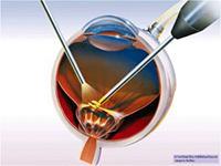 υαλοειδεκτομή