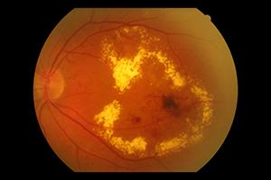 Fundus with Diabetic Macular Oedema